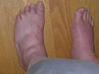 Gut Hastalığı Nasıl Geçer?