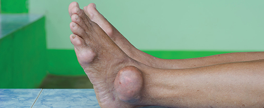 Gut Hastalığı Belirtileri ve Tedavisi